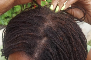 Crown and Sisterlocks after 6 months without retightening